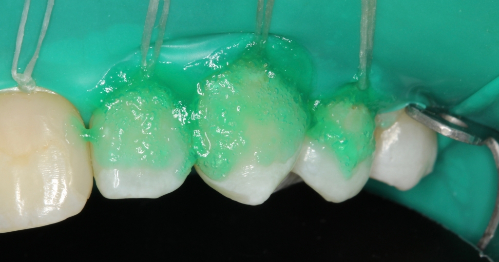 ICON метод лечения дырок в зубе